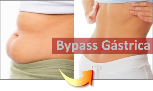 bypass gastrico en honduras